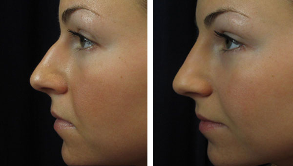 NON SURGICAL RHINOPLASTY WITH DERMAL FILLERS: The 5 Minute Nose Job