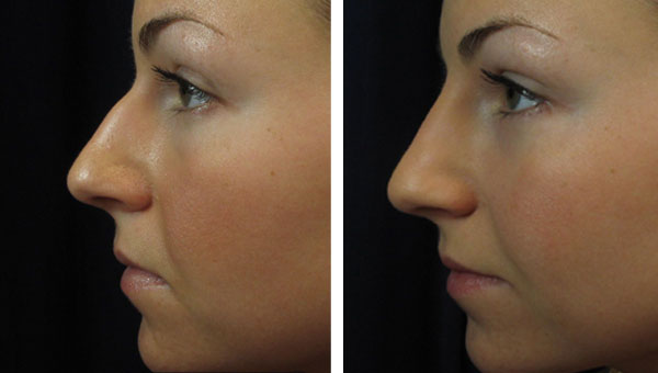 Non Surgical Rhinoplasty - Onyx Medical AestheticsOnyx ...