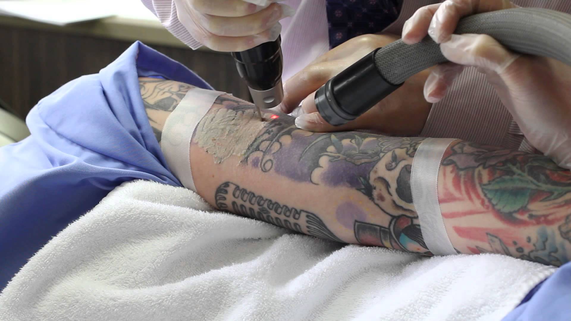 Laser Tattoo Removal Miranda - The #1 Rated Tattoo Removal Clinic // Think  Again Laser Clinic....... Top Rated Miranda Laser Tattoo Removal  Specialists // Free Consults // Think Again Laser Clinic ______